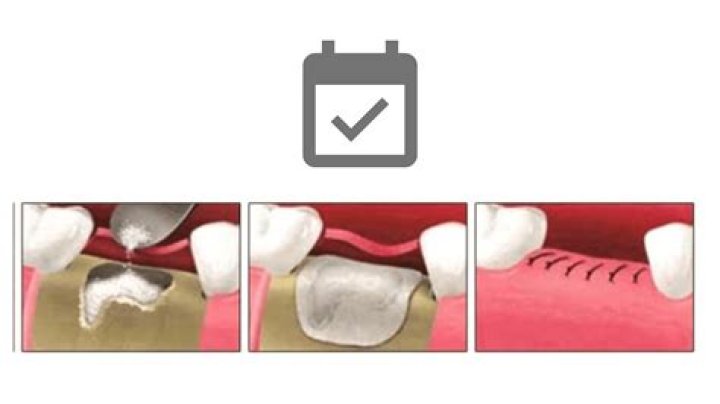 When should I use bench graft?