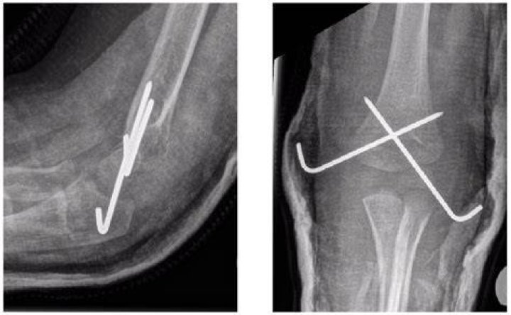 When Should K-wires be removed?