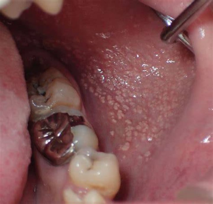 Why do I have a small white spot on my gum?