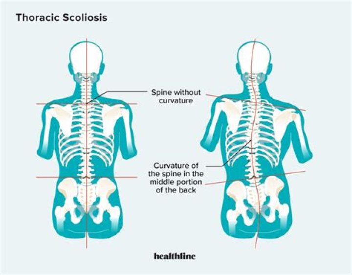Why does my back pop with scoliosis?