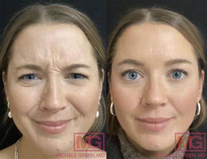 Why has my Botox only lasted a month?
